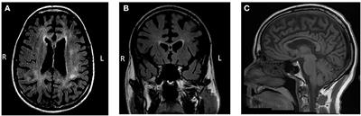 Case Report: Novel CSF1R Variant in a Patient With Behavioral Variant Frontotemporal Dementia Syndrome With Prodromal Repetitive Scratching Behavior